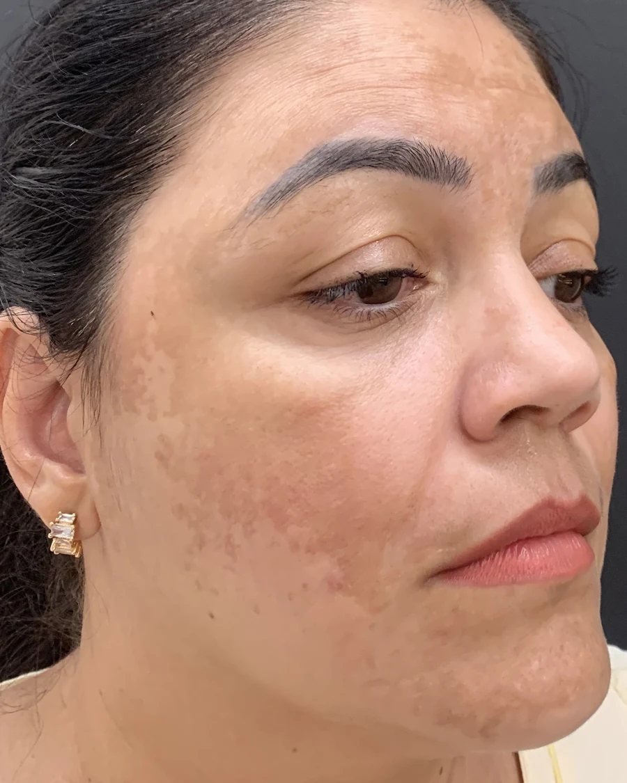 Paciente com melasma antes do tratamento na Skin House